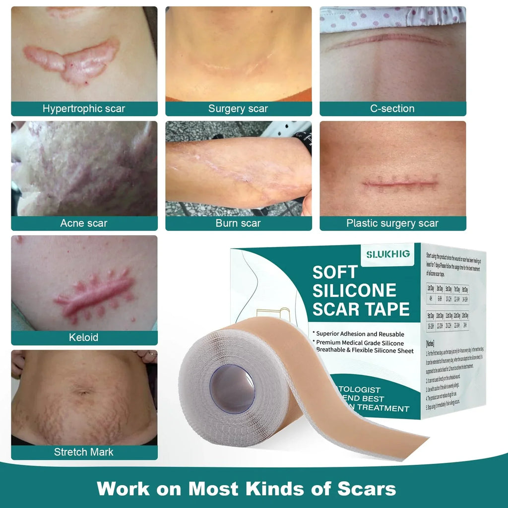 Silicone Scar Sheets (1.6"x 79" Roll-2M), Silicone Scar Tape for Scar Removal Treatment