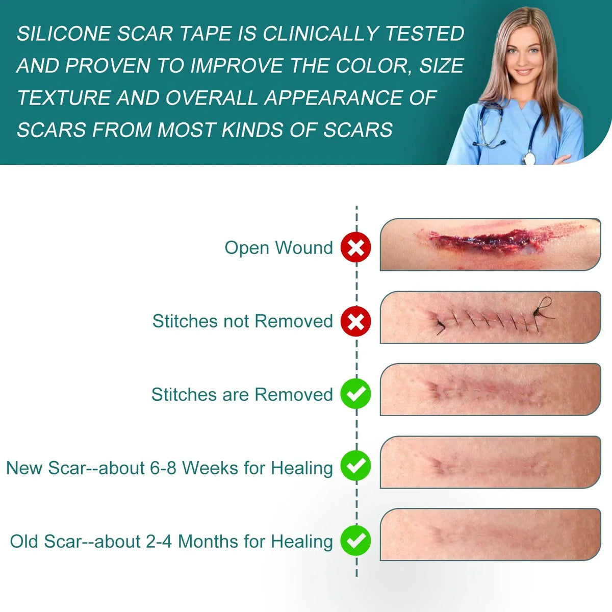 Silicone Scar Sheets (1.6"x 79" Roll-2M), Silicone Scar Tape for Scar Removal Treatment